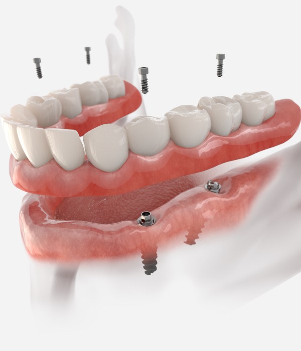 Man considering dental implant retained dentures