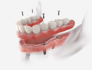 Illustration of dentures being attached to dental implants